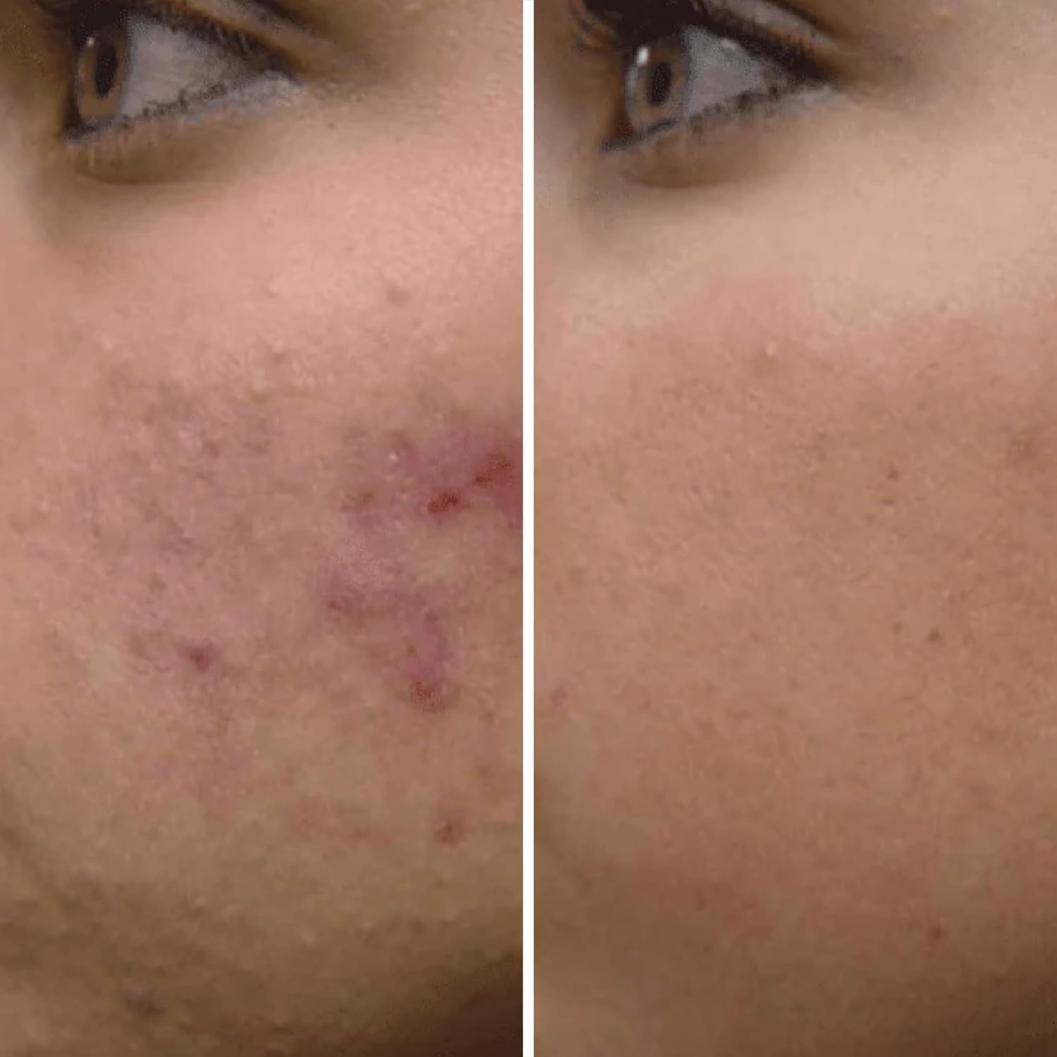 Natural Clear Acne Facial Mask - Image 8